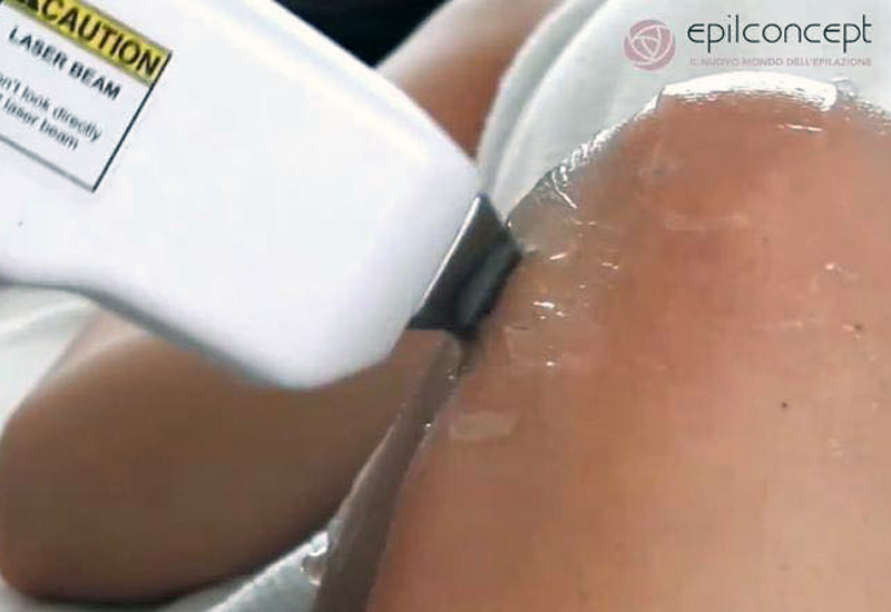 Trattamenti estetici laser diodo 808 epilconcept